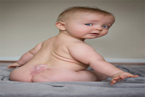 spina bifida occulta newborn
